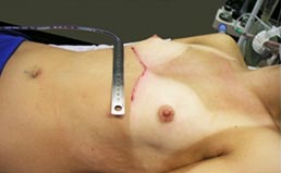 Pós-operatório do Pectus Carinatum