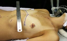 Pré-operatório do Pectus Carinatum