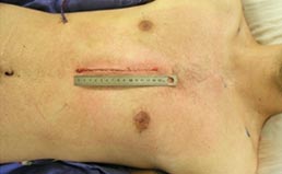 Pós-operatório do Pectus Excavatum