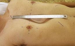 Pré-operatório do Pectus Excavatum