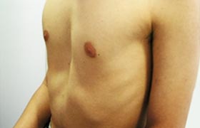 tratamento pectus