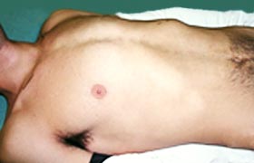 o que é pectus Pectus carinatum