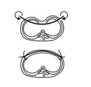 pectus-excavatum