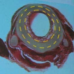 Corte transversal da região subglótica (cartilagem cricóide) apresentando uma estenose circunferencial. Na linha tracejada em amarelo, demonstramos a área da cartilagem cricóide que deve ser ressecada.