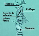 Sequência da uma cirurgia de correção de fístula esofagotraqueal