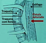 Sequência da uma cirurgia de correção de fístula esofagotraqueal