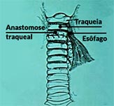 Sequência da uma cirurgia de correção de fístula esofagotraqueal