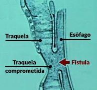 Gravura esquemática da fístula.