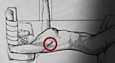 Local da região torácica onde é realizada a incisão (corte) para a cirurgia da fístula traqueoesofágica inferior e também da fístula do esofagobrônquica.