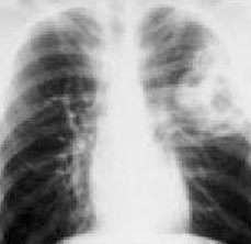Radiografia de malformação adenomatoide cística tipo I (área esbranquiçada multicística no lado direito da imagem).