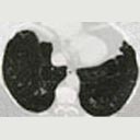 Tomografia do tórax com enfisema (áreas mais escuras).