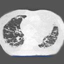 Tomografias do tórax com imagens de algumas das alterações pulmonares difusas.