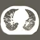 Tomografias do tórax com imagens de algumas das alterações pulmonares difusas.