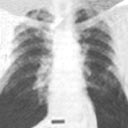 Uma radiografia e uma tomografia do tórax com imagem de outras alterações pulmonares difusas.