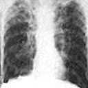 Radiografia do tórax com tuberculose no ápice