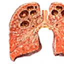 Imagem demonstrativa da tuberculose no ápice
