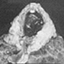 Segmento destruído do pulmão ressecado (retirado) devido a seqüelas de tuberculose.