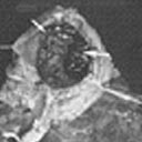 Segmento destruído do pulmão ressecado (retirado) devido a seqüelas de tuberculose.